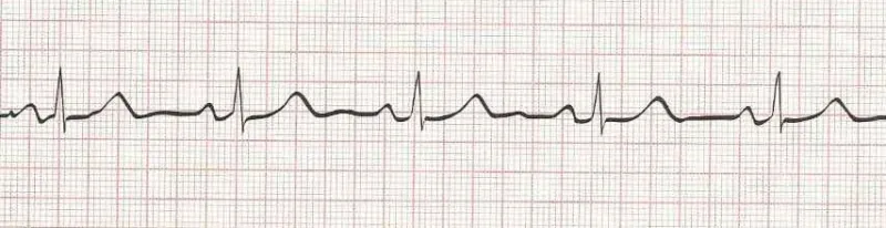 Sinus Bradycardia with 1st degree AV block  (PR 0.22 seconds) HR=50