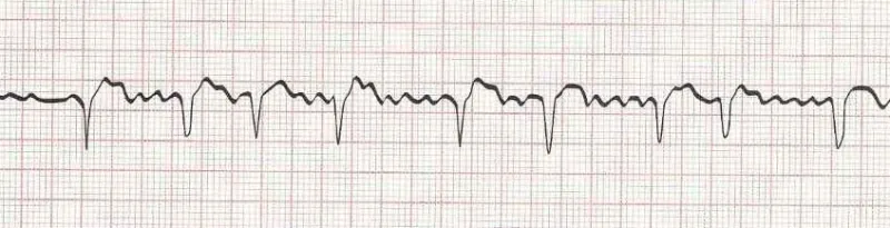 Atrial flutter with varying conduction (saw tooth baseline)