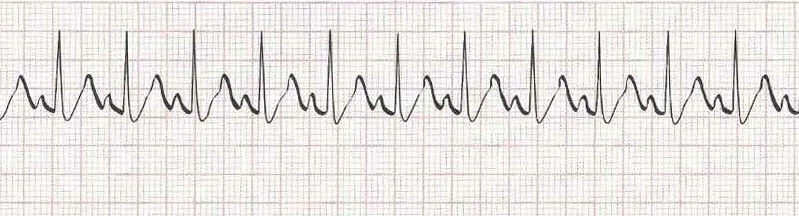 Sinus Tachycardia - heart rate greater than 100