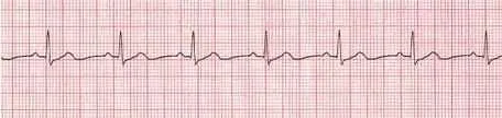 Normal Sinus Rhythm