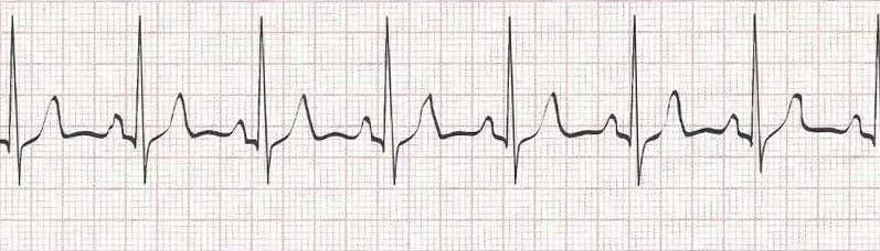 Normal Sinus Rhythm