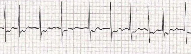 Atrial Fibrillation (irregular rhythm without discernible P waves)