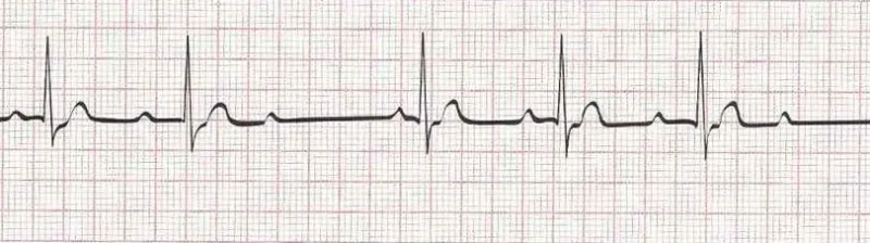 Second degree AV block type I (wenckebach) PR longer, longer, dropped beat