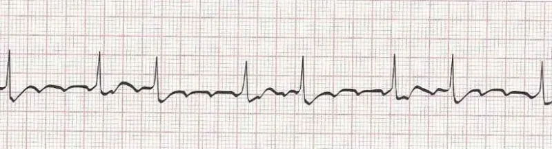 Atrial flutter (basic)  atrial tachycardia with block if more advanced
