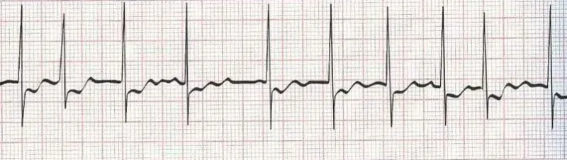 Atrial fibrillation/flutter  goes between no discernible P's and flutter waves.