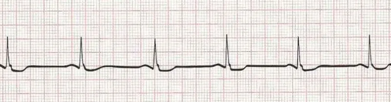 Normal Sinus Rhythm