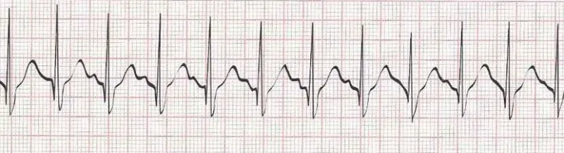Sinus tachycardia - heart rate greater than 100