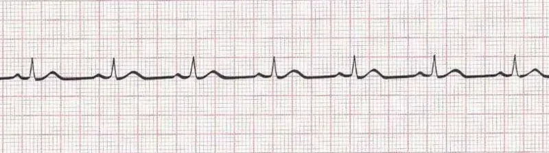 Normal sinus rhythm
