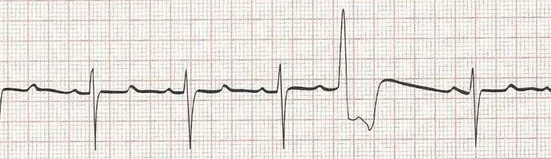 Sinus rhythm with PVC