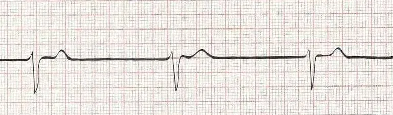 Junctional rhythm (rate of 30)