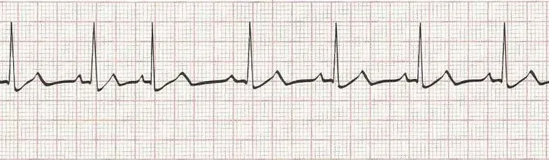 Sinus rhythm with premature atrial contraction (PAC 3rd beat)
