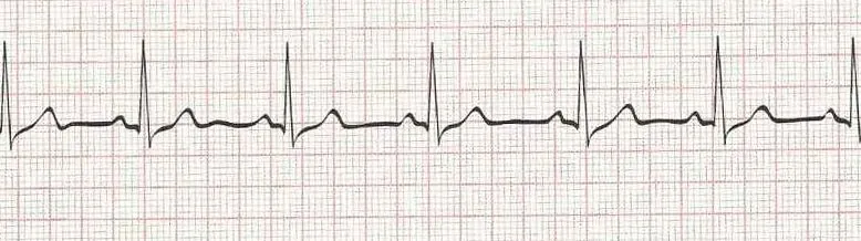 Normal sinus rhythm