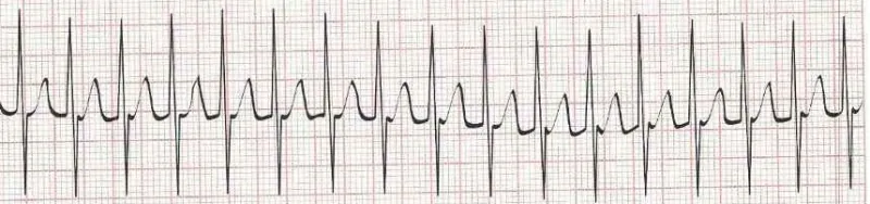 Supraventricular Tachycardia (SVT)  Narrow complex tachycardia