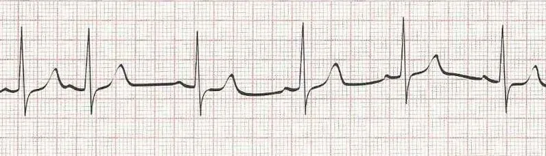 Sinus rhythm with a PAC (second beat)