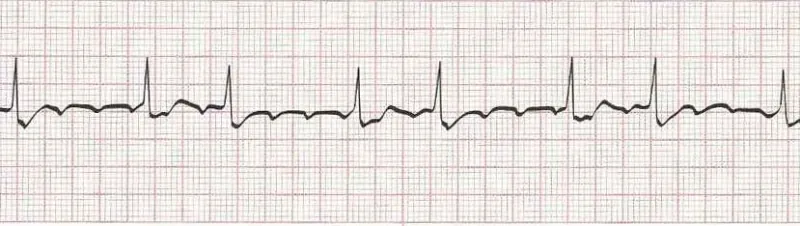 Atrial flutter (basic)  atrial tachycardia with block if more advanced