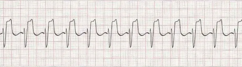 Sinus tachycardia - heart rate greater than 100