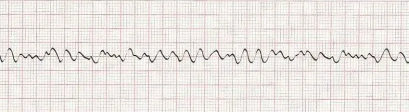 Ventricular fibrillation