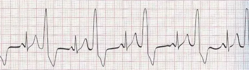 Sinus rhythm with ventricular bigeminy (PVC every other beat)