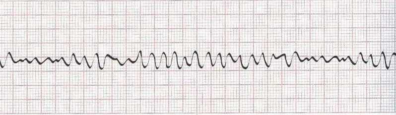 Ventricular fibrillation