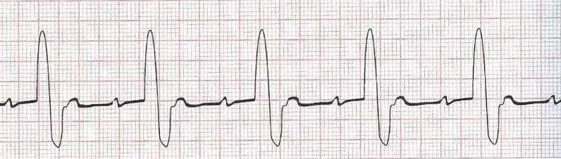 Sinus bradycardia with 1st degree AV block  (PR 0.26 seconds) HR=50