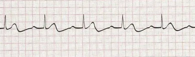 Sinus rhythm with 1st degree AV block (PR -.26 seconds)