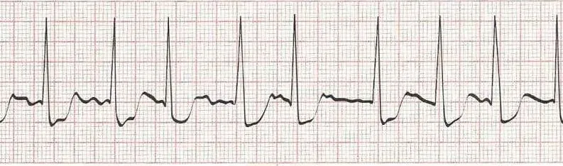 Atrial fibrillation (irregular rhythm without discernible P waves)