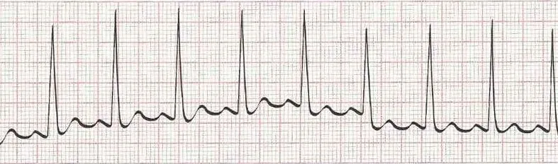Sinus rhythm (could call this sinus tachycardia HR 100)
