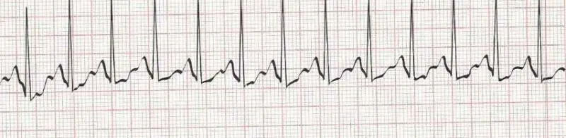 Sinus Tachycardia - heart rate greater than 100