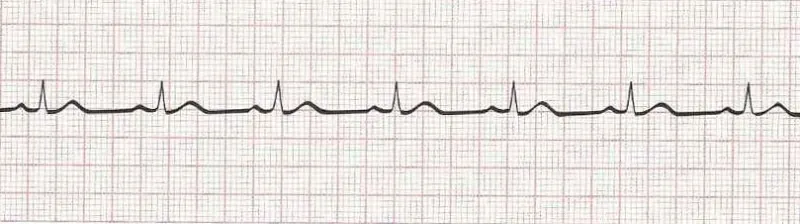 Normal sinus rhythm