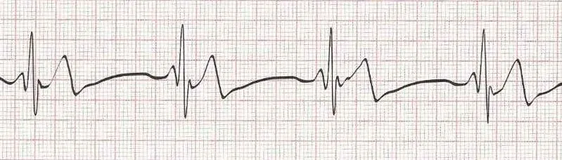 Sinus bradycardia HR 40