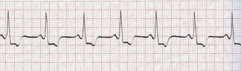 Normal sinus rhythm