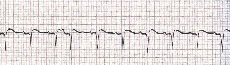 Sinus rhythm with premature atrial contraction (PAC 4th beat)