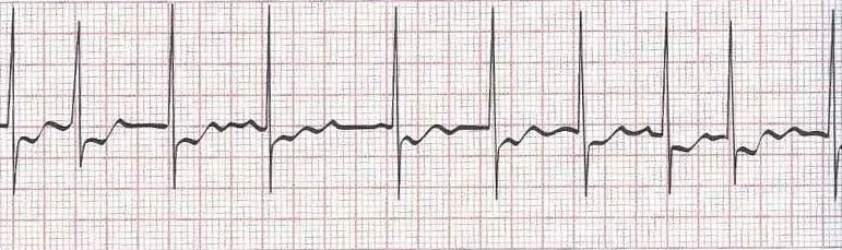 Atrial fibrillation