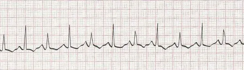 Sinus rhythm with ventricular bigeminy (PVC every other beat)