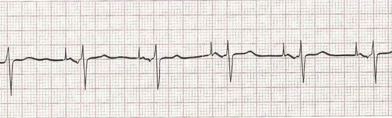 Sinus rhythm with AV sequential pacing (atrial firing and conducting)