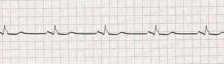 Sinus bradycardia (HR=50)