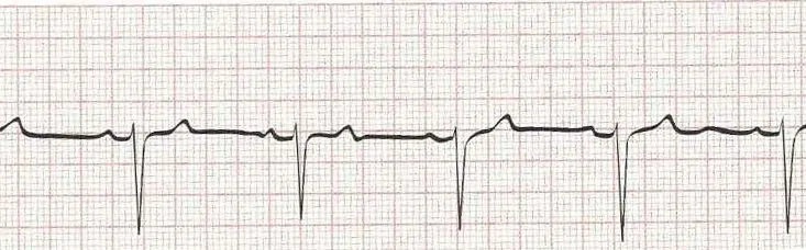 Normal sinus rhythm