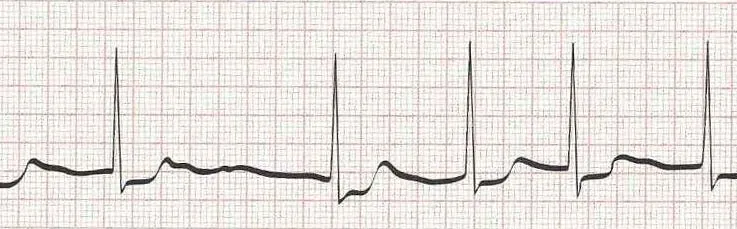 Atrial fibrillation  (irregular rhythm without discernible P waves)