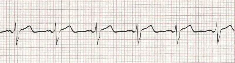 Normal Sinus Rhythm