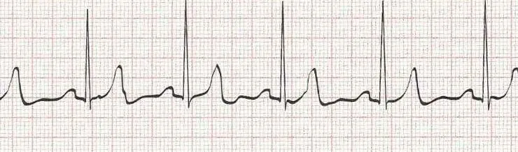 Normal sinus rhythm