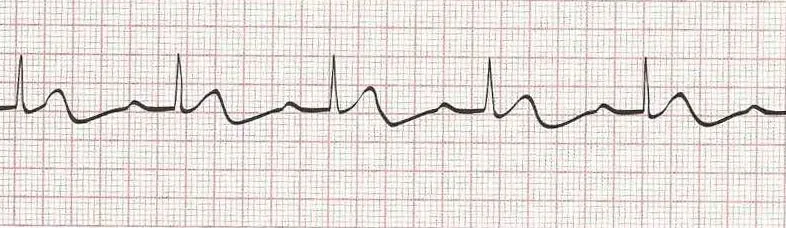 Sinus rhythm with 1st degree AV block (PR -.26 seconds)