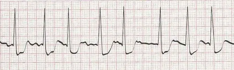 Atrial fibrillation (with a few flutter beats)