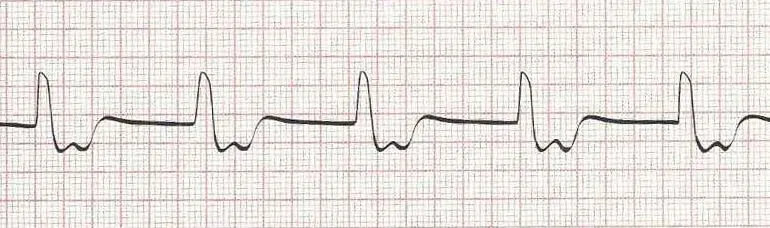 Junctional rhythm (P waves occur after the QRS with HR 50)