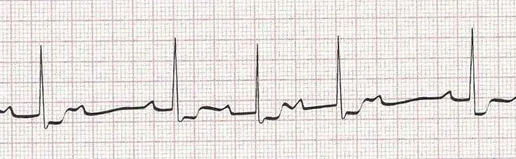 2nd degree AV block mobitz I (wenckebach)  PR gets longer, longer then dropped QRS