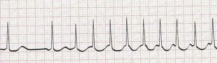SR (beginning) to supraventricular tachycardia (SVT) : narrow complex tachycardia