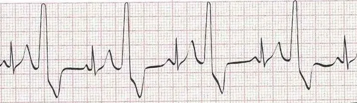 Sinus rhythm with ventricular bigeminy (PVC every other beat)