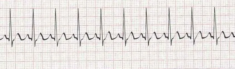 Sinus tachycardia - heart rate greater than 100