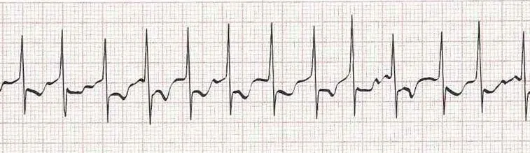 Atrial fibrillation (irregular rhythm without discernible P waves)