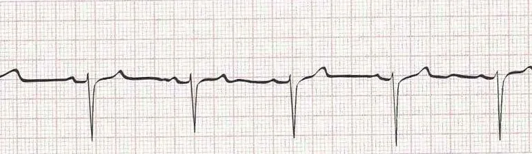 Wandering atrial pacemaker (p waves look different)