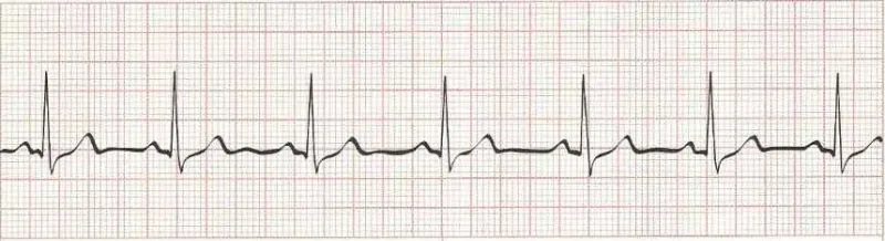 Normal Sinus Rhythm